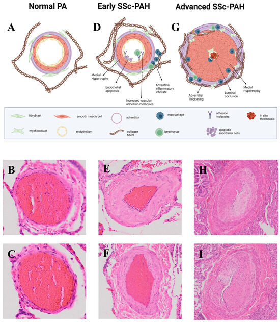【翌日発送可能】 Systemic Sclerosis-Associated Arterial Pulmonary 健康家電