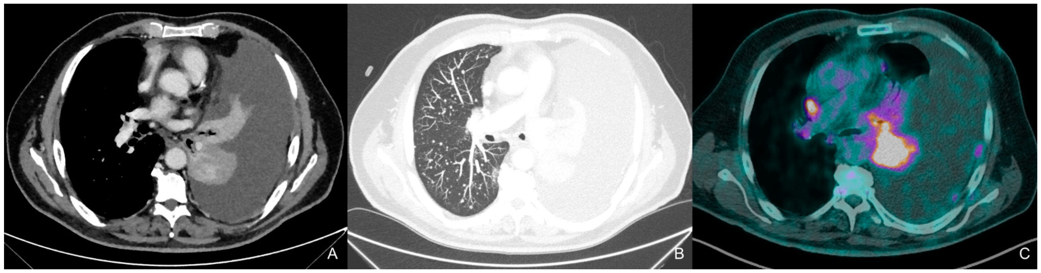Near-Complete Response to Osimertinib for Advanced Non-Small