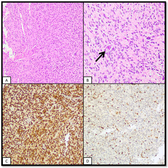 Molecular and Pathological Features of Paediatric High-Grade Gliomas