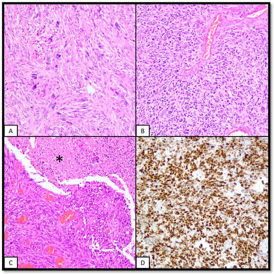Molecular and Pathological Features of Paediatric High-Grade Gliomas