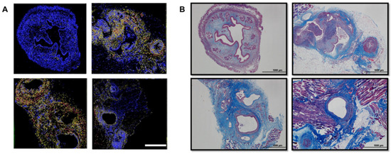 The Regulation of MicroRNA-21 by Interleukin-6 and Its Role in the ...