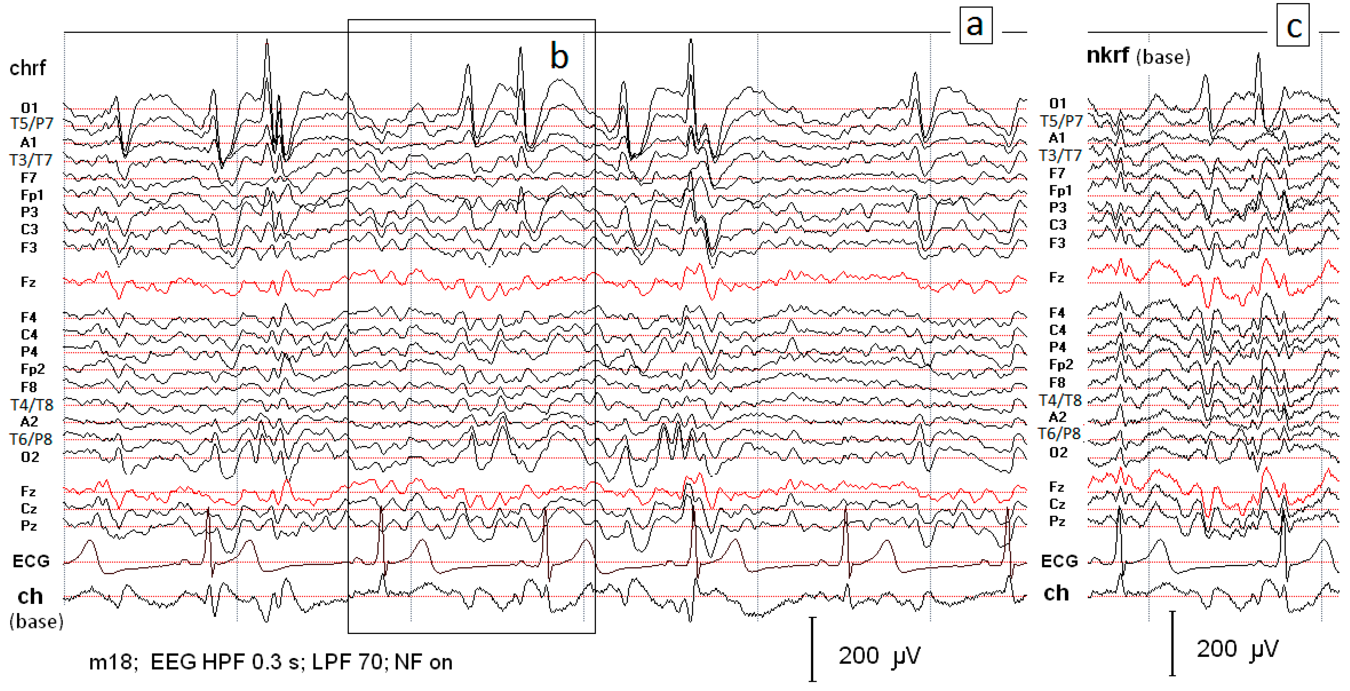 Automatic Detection of the EEG Spike–Wave Patterns in