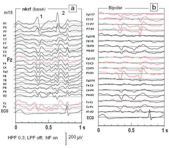 Automatic Detection of the EEG Spike–Wave Patterns in