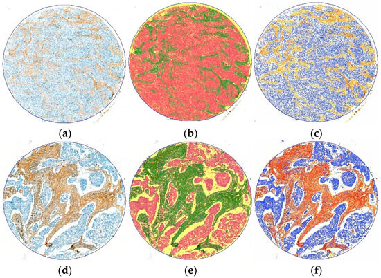 Digital Whole Slide Image Analysis of Elevated Stromal
