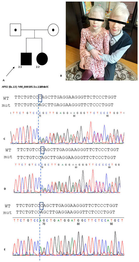 Masks of Albinism: Clinical Spectrum of Hermansky–Pudlak