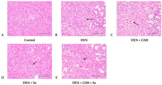 Glutathione and Selenium Supplementation Attenuates Liver Injury in  Diethylnitrosamine-Induced Hepatocarcinogenic Mice by Enhancing Glutathione-Related  Antioxidant Capacities