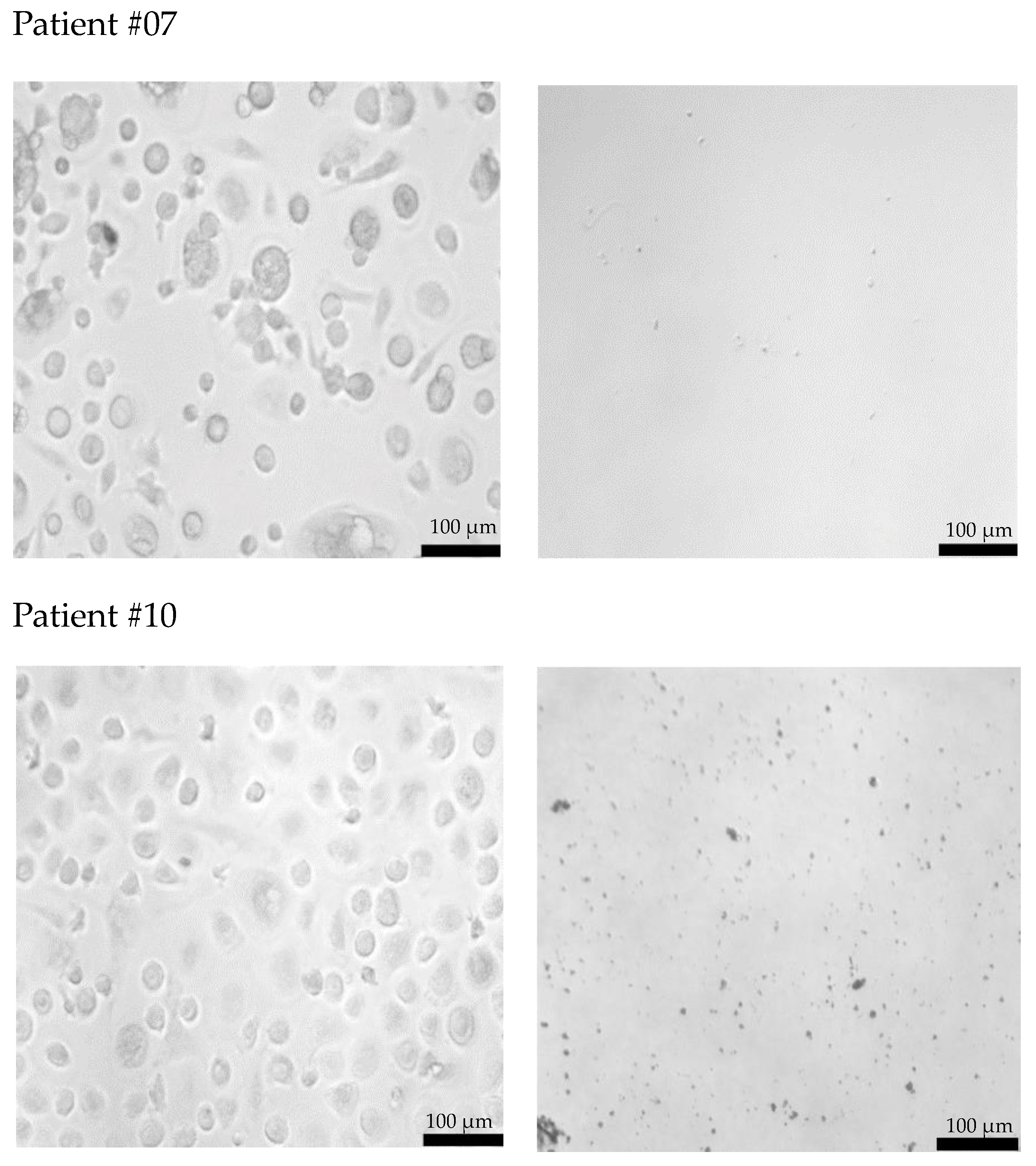【Marie】 Extracellular Hsp70 and Circulating Endometriotic Cells as