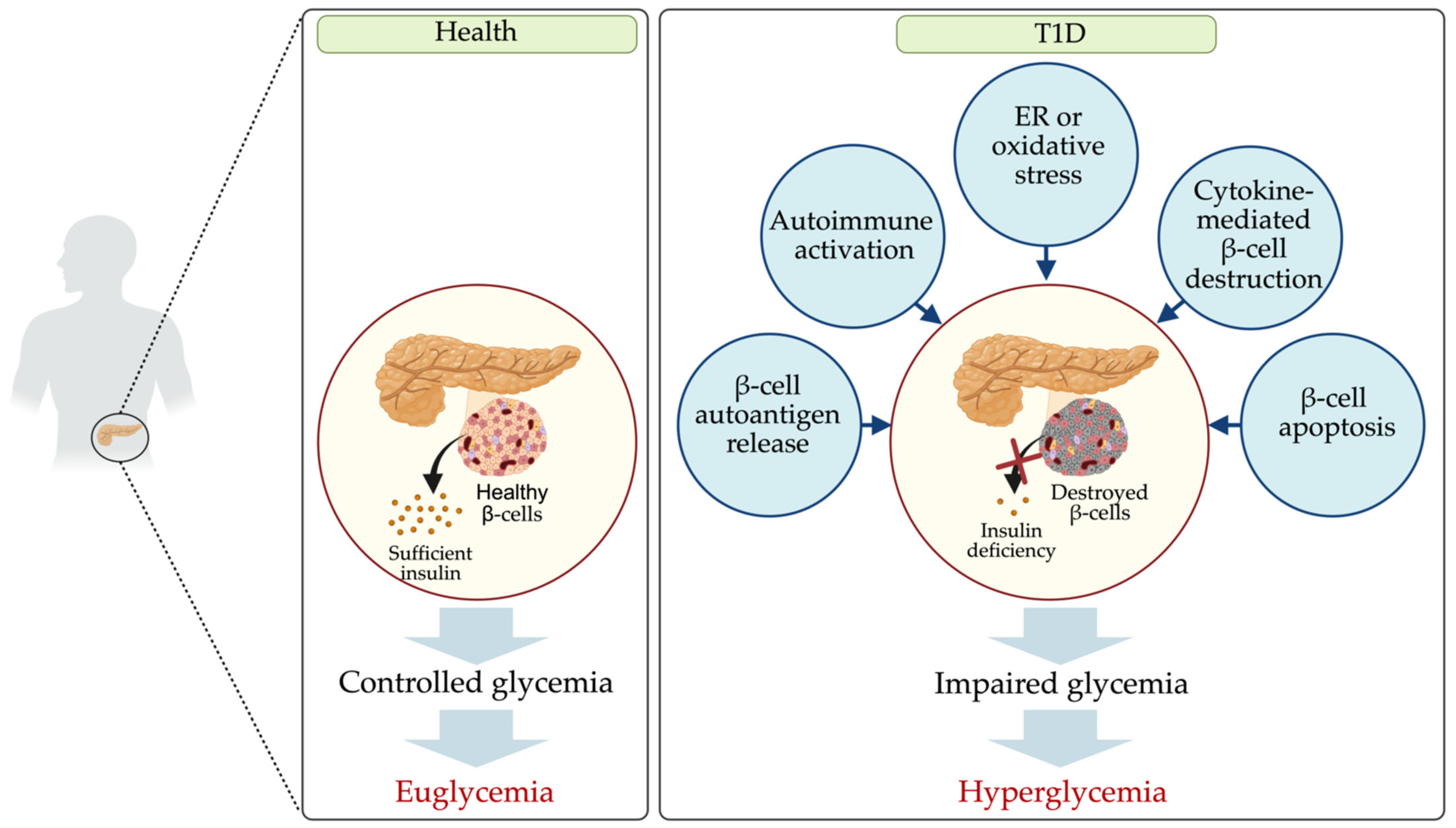 microRNAs in Type 1 Diabetes: Roles, Pathological Mechanisms microRNAs in Type 1 Diabetes: Roles, Pathological Mechanisms