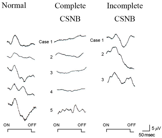 Review of Four Refined Clinical Entities in Hereditary Retinal