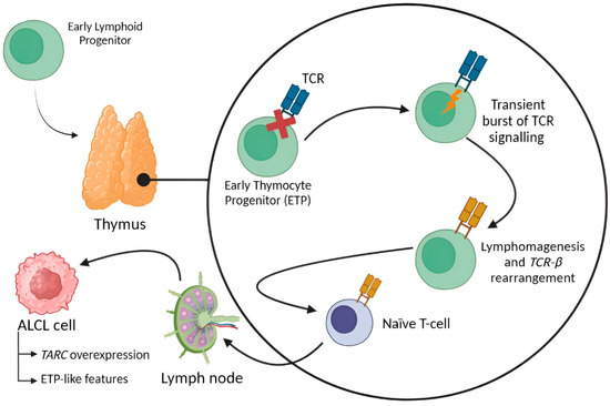 Molecular Insights into the Diagnosis of Anaplastic Large