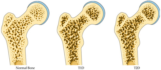 Recent Updates on Diabetes and Bone