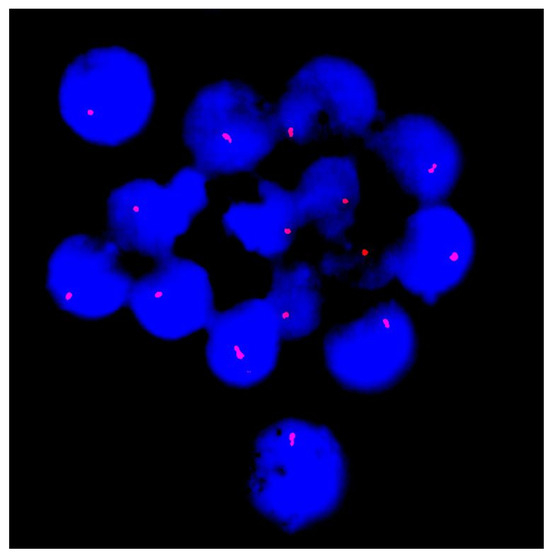 13q Deletion Syndrome Presenting with Lymphopenia Detected Through