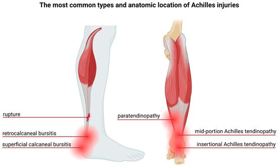 glutathione tendonitis Fluoroquinolone-Induced Achilles Tendon Damage: Structural and Biochemical  Insights into Collagen Type I Alterations