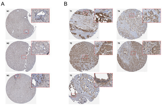 Silencing of Kinesin Light Chain 1 Suppresses Aggressive