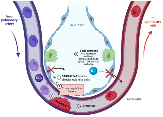 Glutathione Depletion in Acute Respiratory Distress Syndrome: Mechanistic Significance and Potential Association with Ventilatory Support