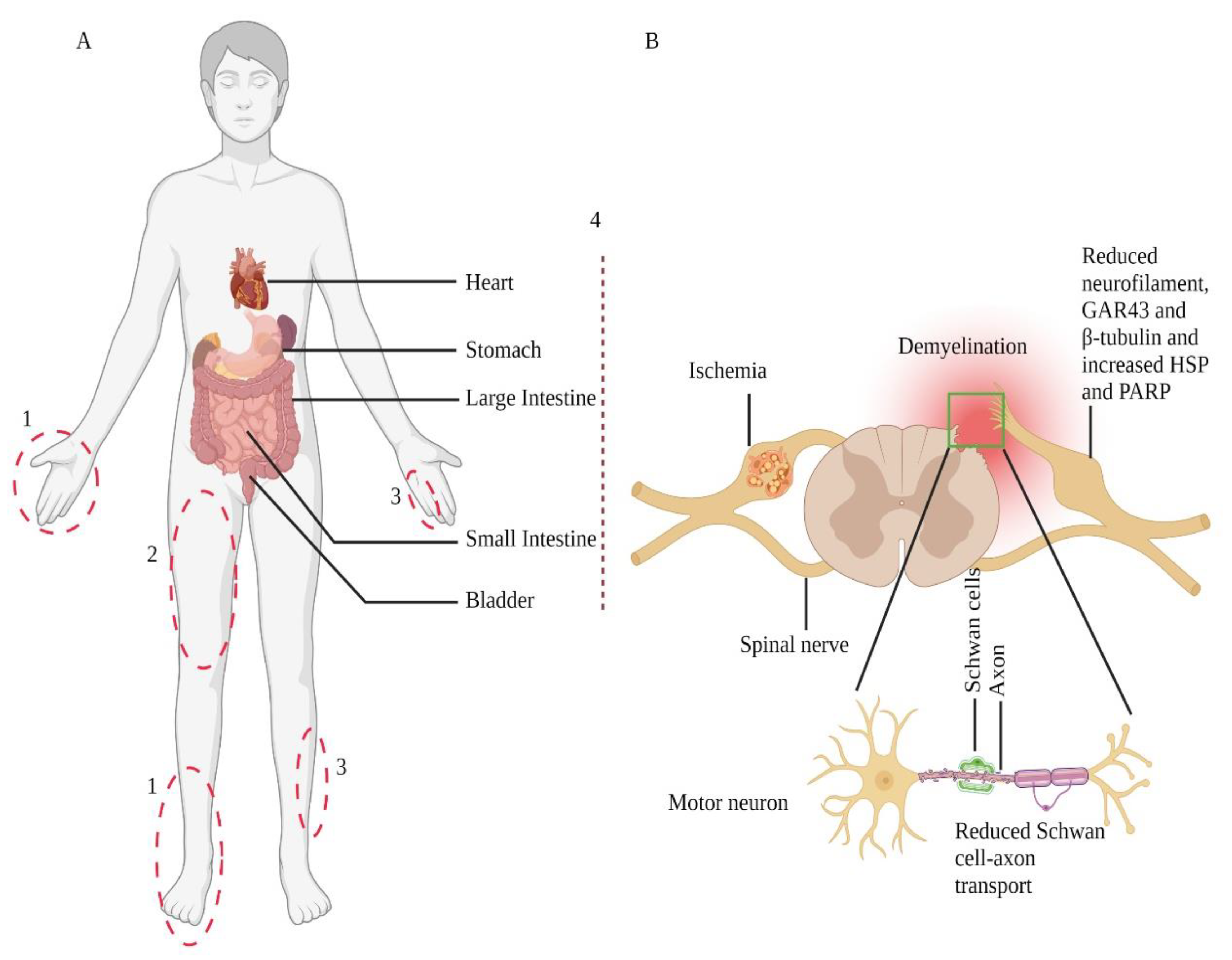 diabetic peripheral autonomic neuropathy icd 10