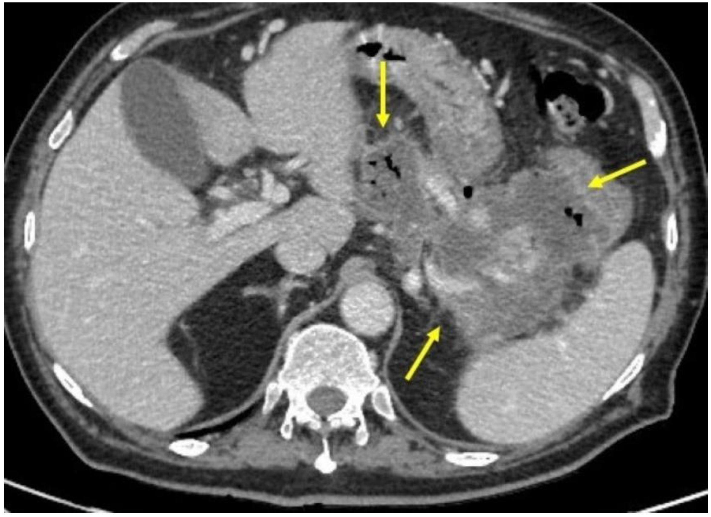 Successful Treatment Of Pancreatic Pseudocysto Duodenum Fistula With successful-treatment-of-pancreatic-pseudocysto-duodenum-fistula-with
