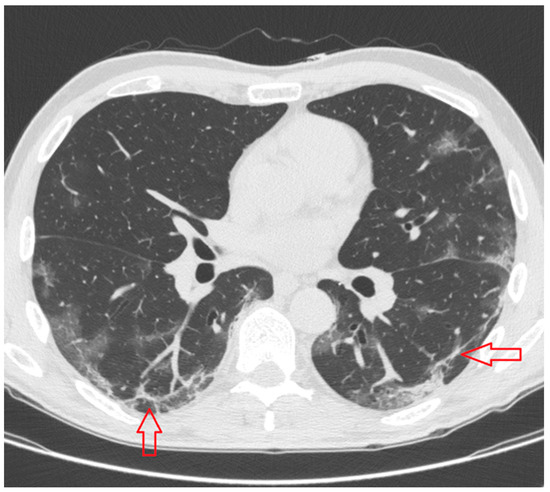 肺HRCT A New HRCT Score for Diagnosing SARS-CoV-2 Pneumonia: A