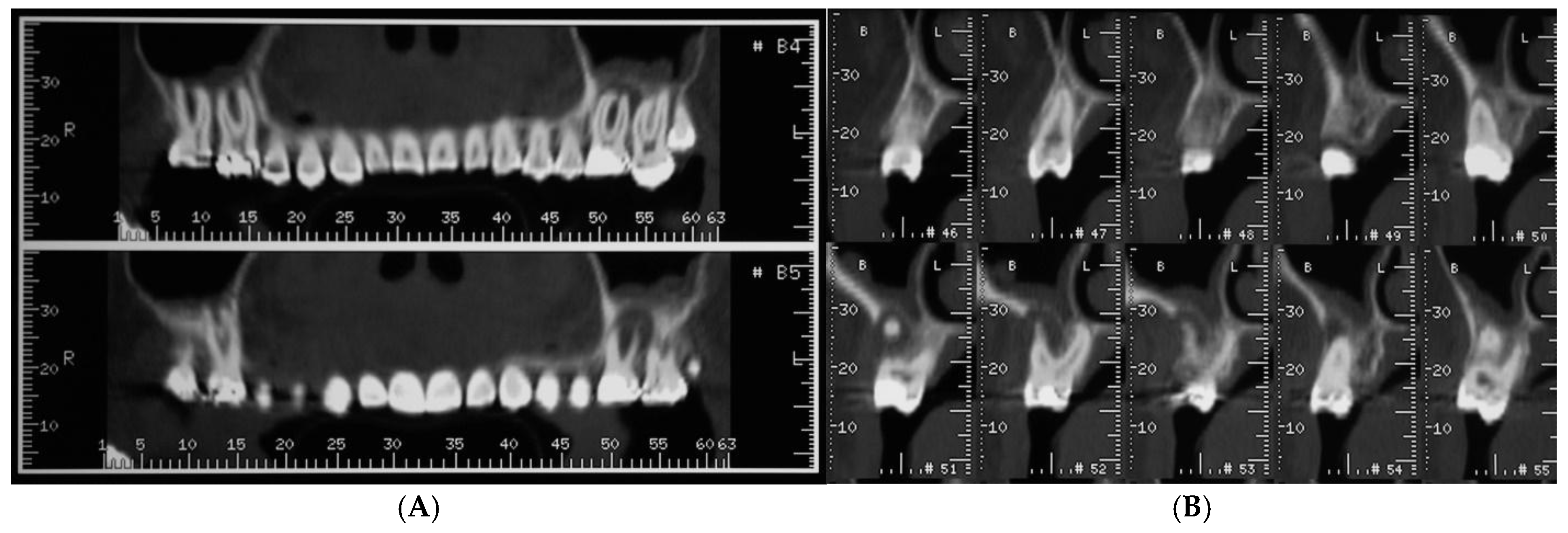 歯科 ZERO別冊 歯牙形態 Natural Tooth Morphology