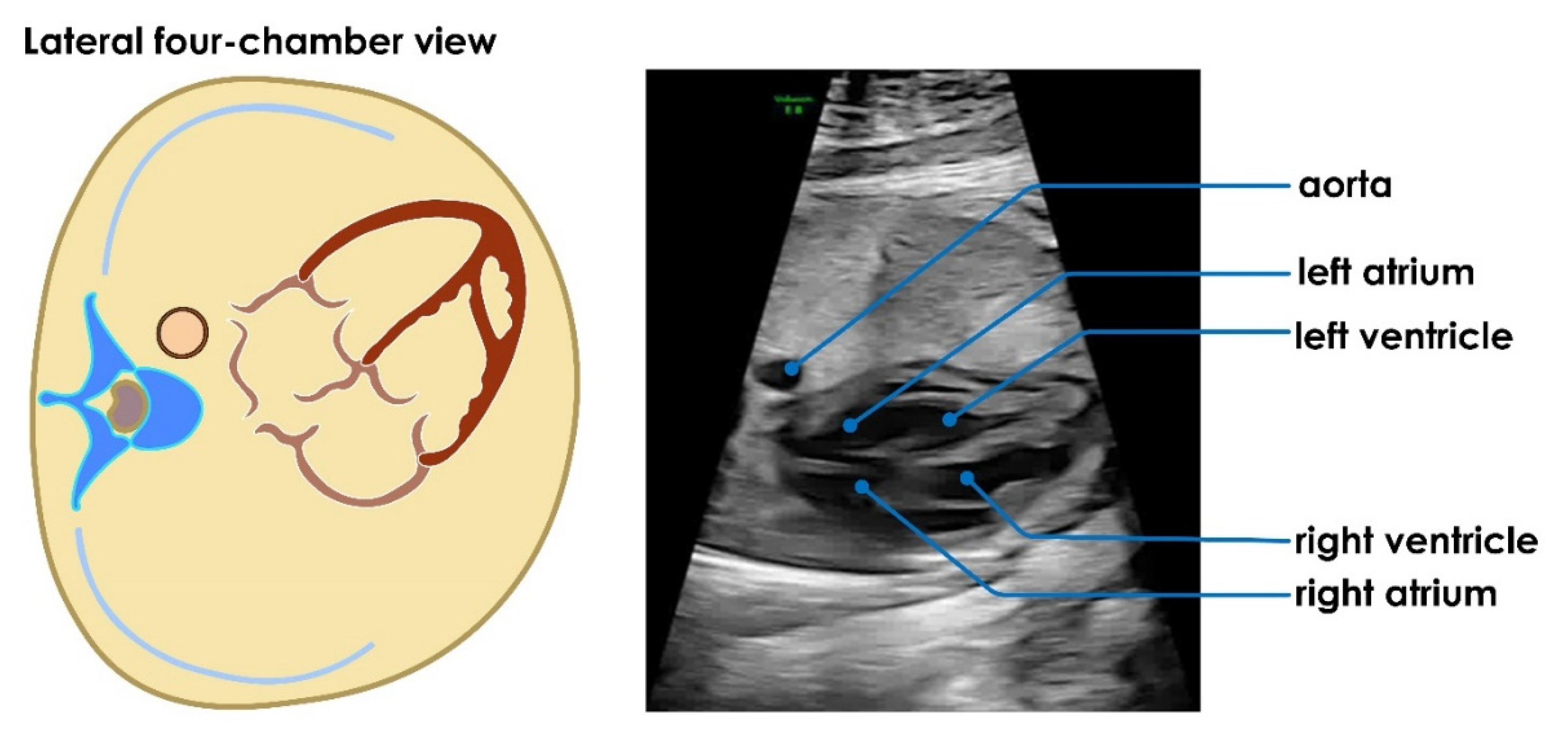 Solved] Midsagittal plane Umbilical plane Coronal plane, Subcostal plane.