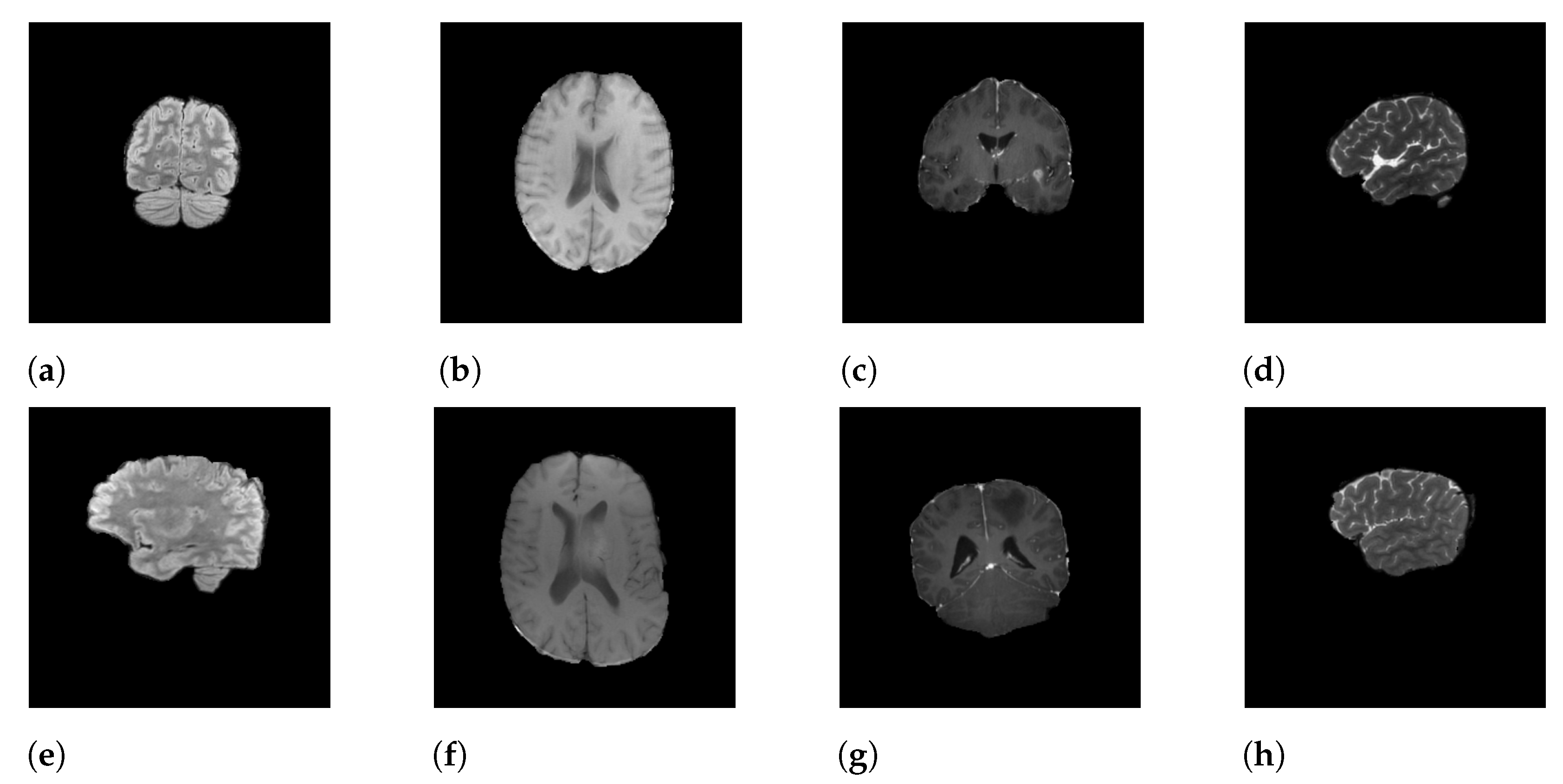 An Attentive Multi-Modal CNN for Brain Tumor Radiogenomic