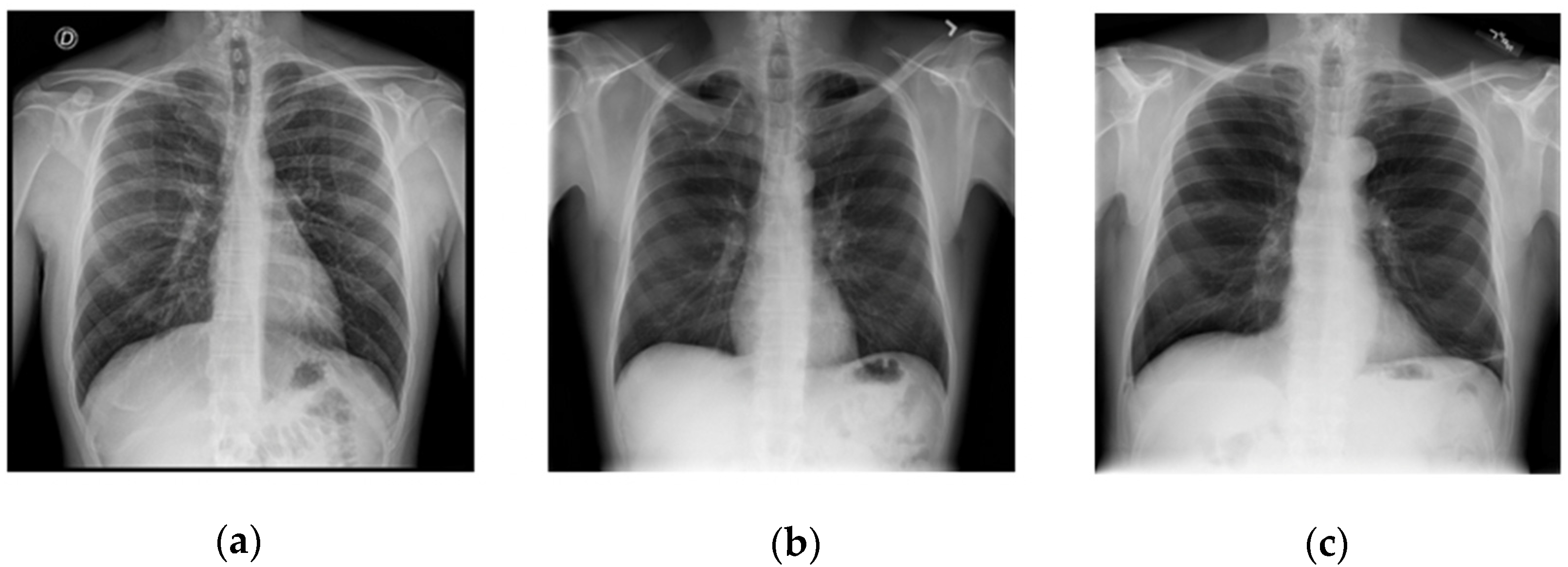 Information Free FullText The Detection of COVID19 in Chest X
