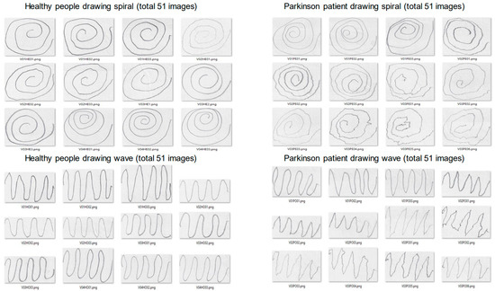 Early Parkinson’s Disease Diagnosis through Hand-Drawn Spiral and Wave ...