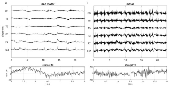 Patient-Independent Epileptic Seizure Detection with Reduced EEG