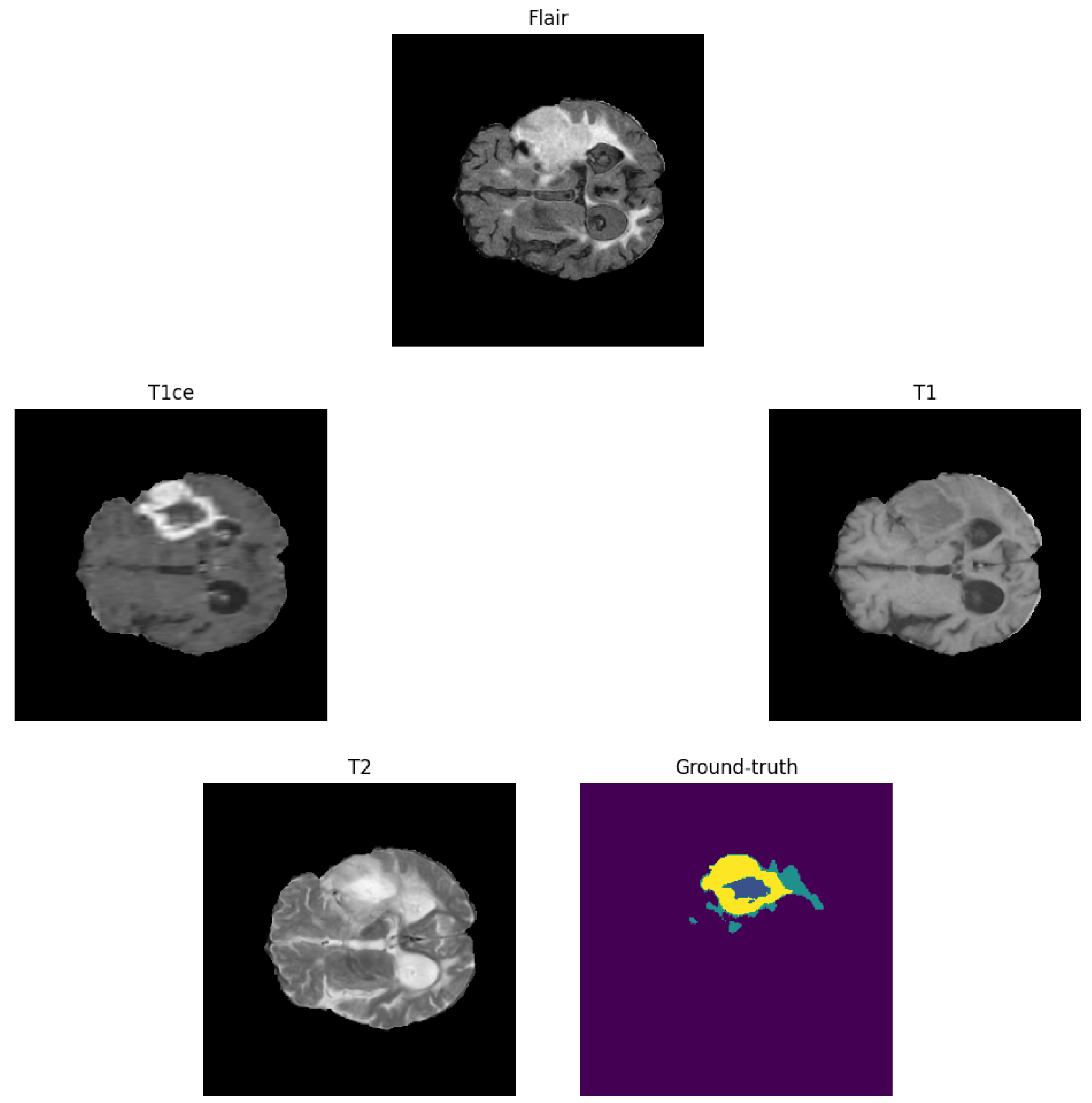 Brain Tumour Segmentation Using Choquet Integrals and Coalition Game