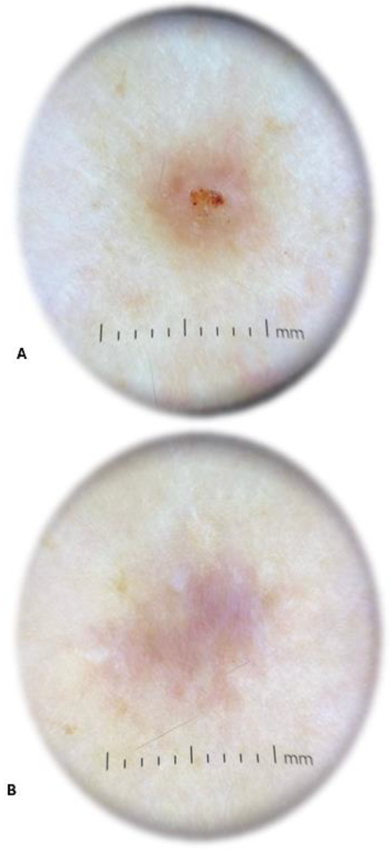 Tick Bite Granuloma After Incomplete Removal Of Ixodes Ricinus Tick 