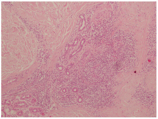 Tick Bite Granuloma After Incomplete Removal Of Ixodes Ricinus Tick 