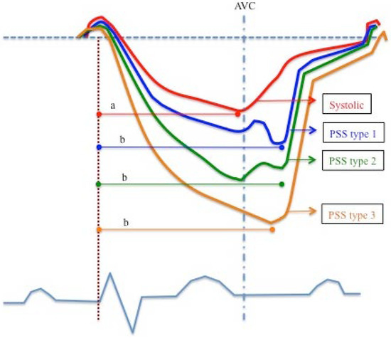 Assessment of Postsystolic Shortening and Global Longitudinal