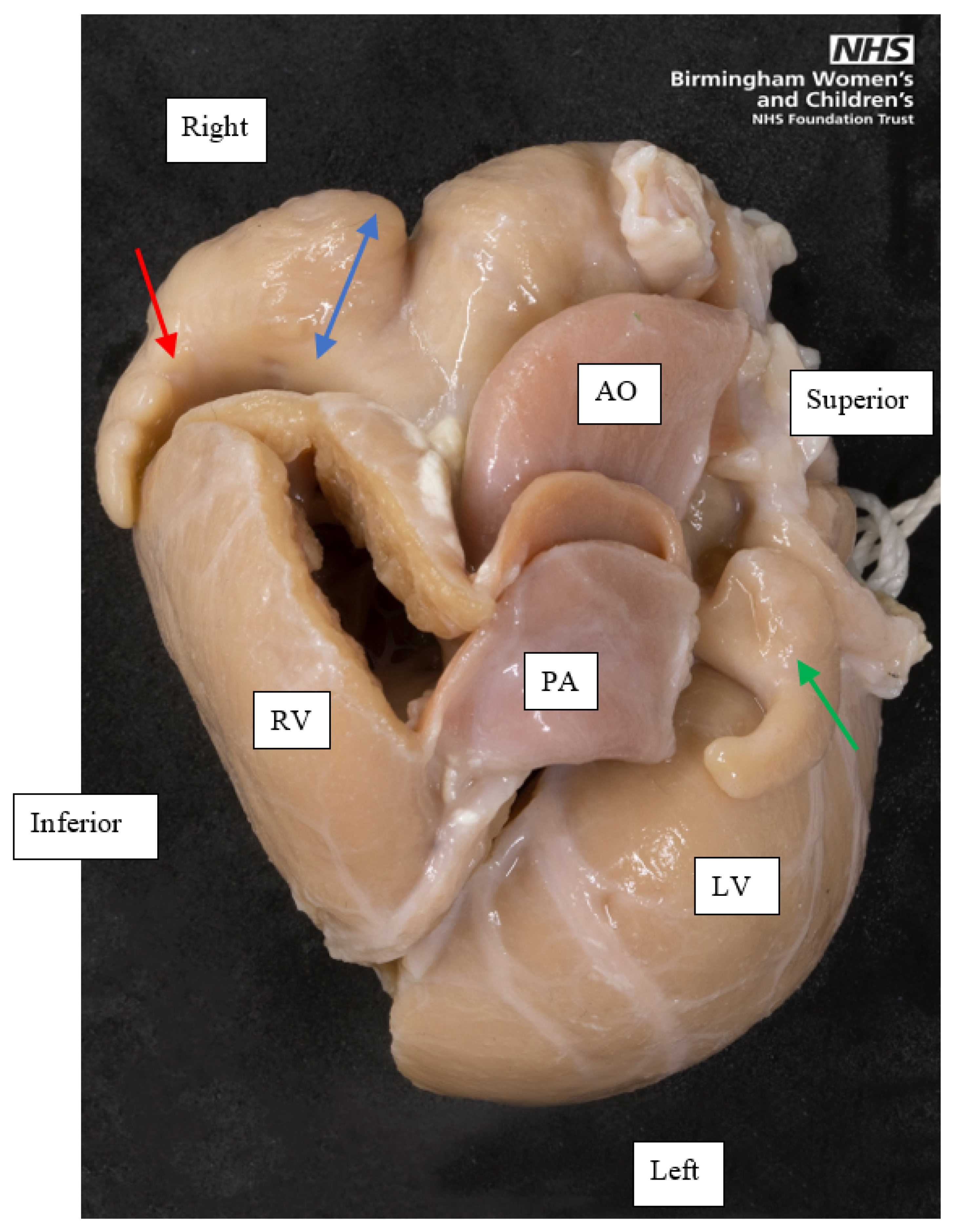 JCDD | Free Full-Text | Congenitally Malformed Hearts ...