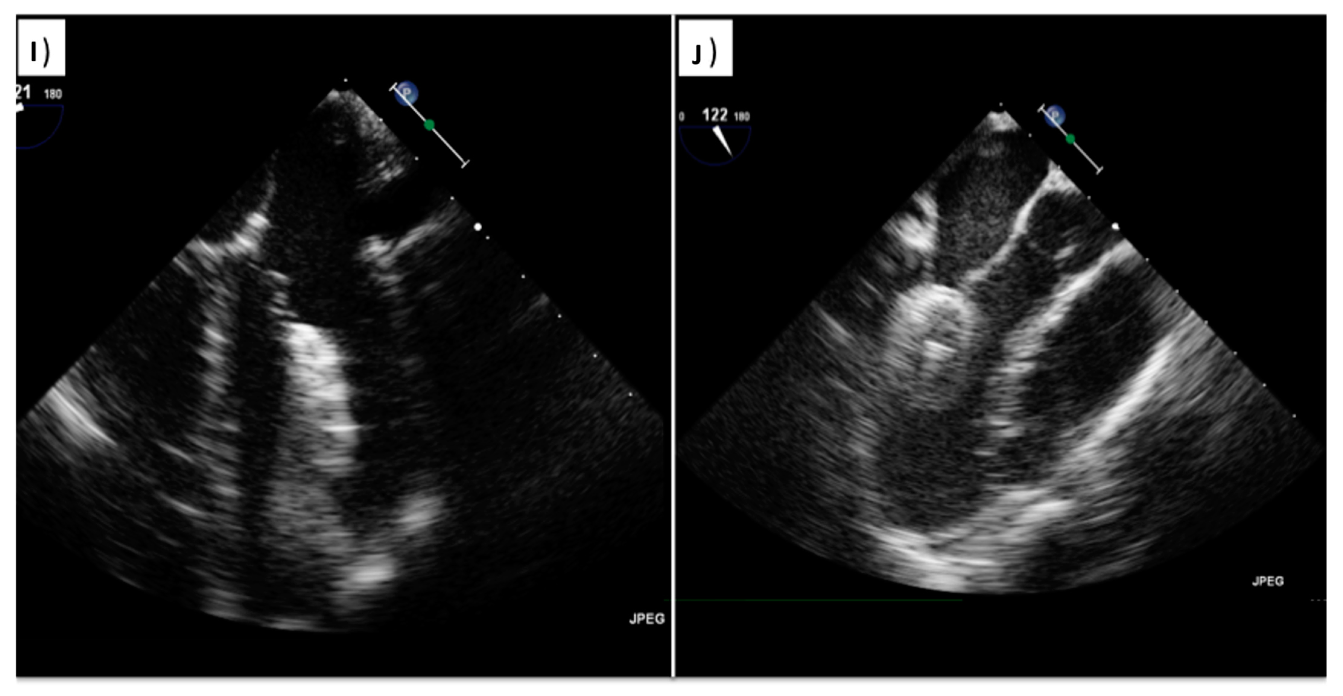JCDD Free FullText Transcatheter Closure of PFO and ASD