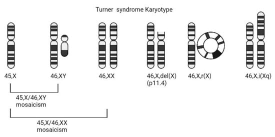 turner syndrome pdf info