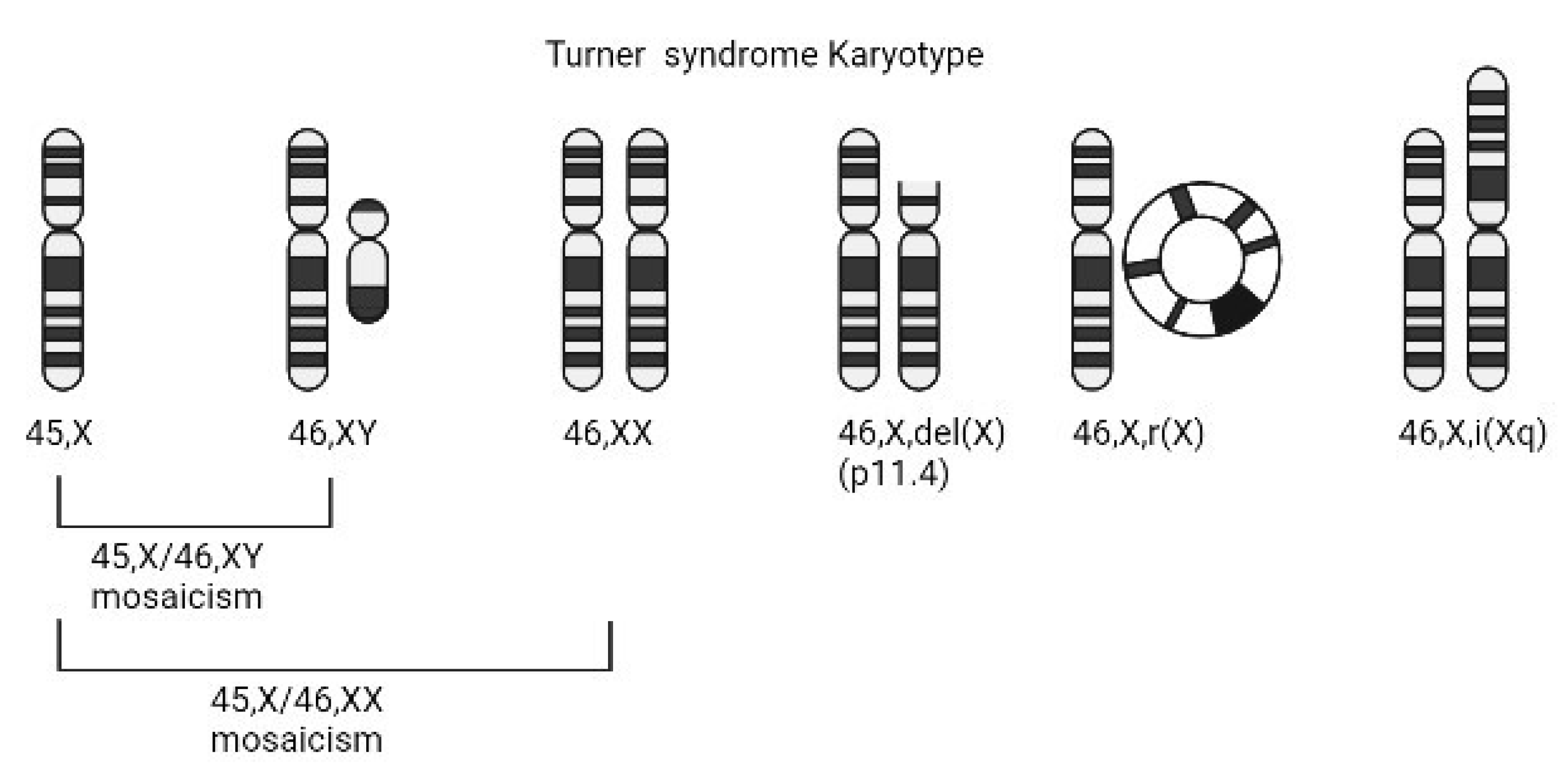 turner syndrome facts