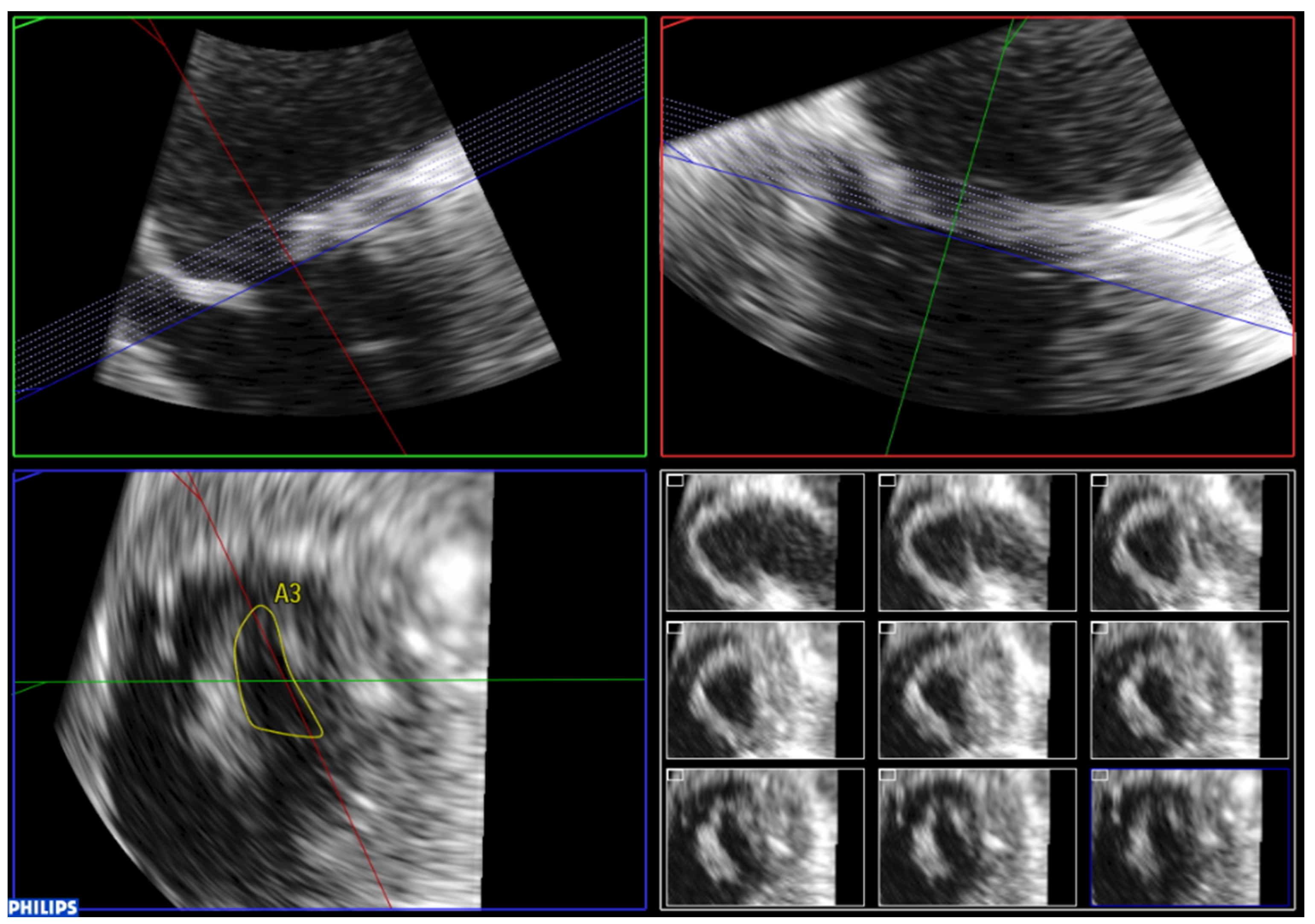 Jcdd Free Full Text The Role Of 2d And 3d Echo In Mitral Stenosis Html Jcdd Free Full Text The Role Of 2d And 3d Echo In Mitral Stenosis Html