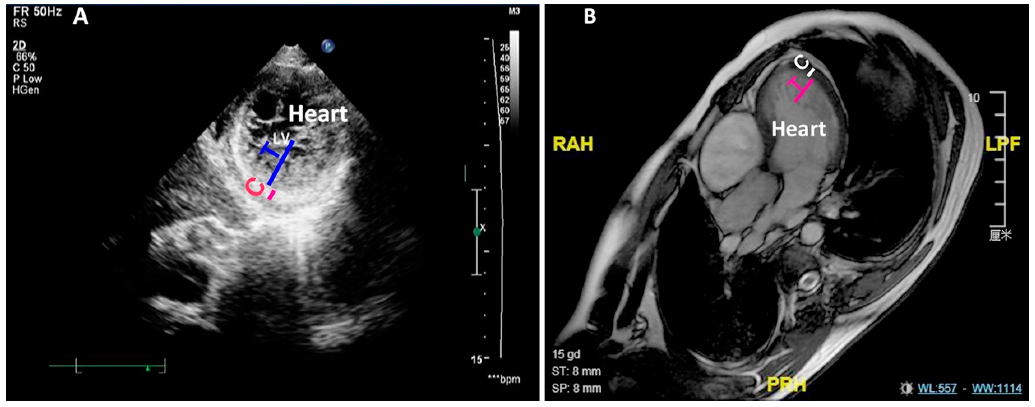 JCDD | Free Full-Text | Left Ventricular Noncompaction Is