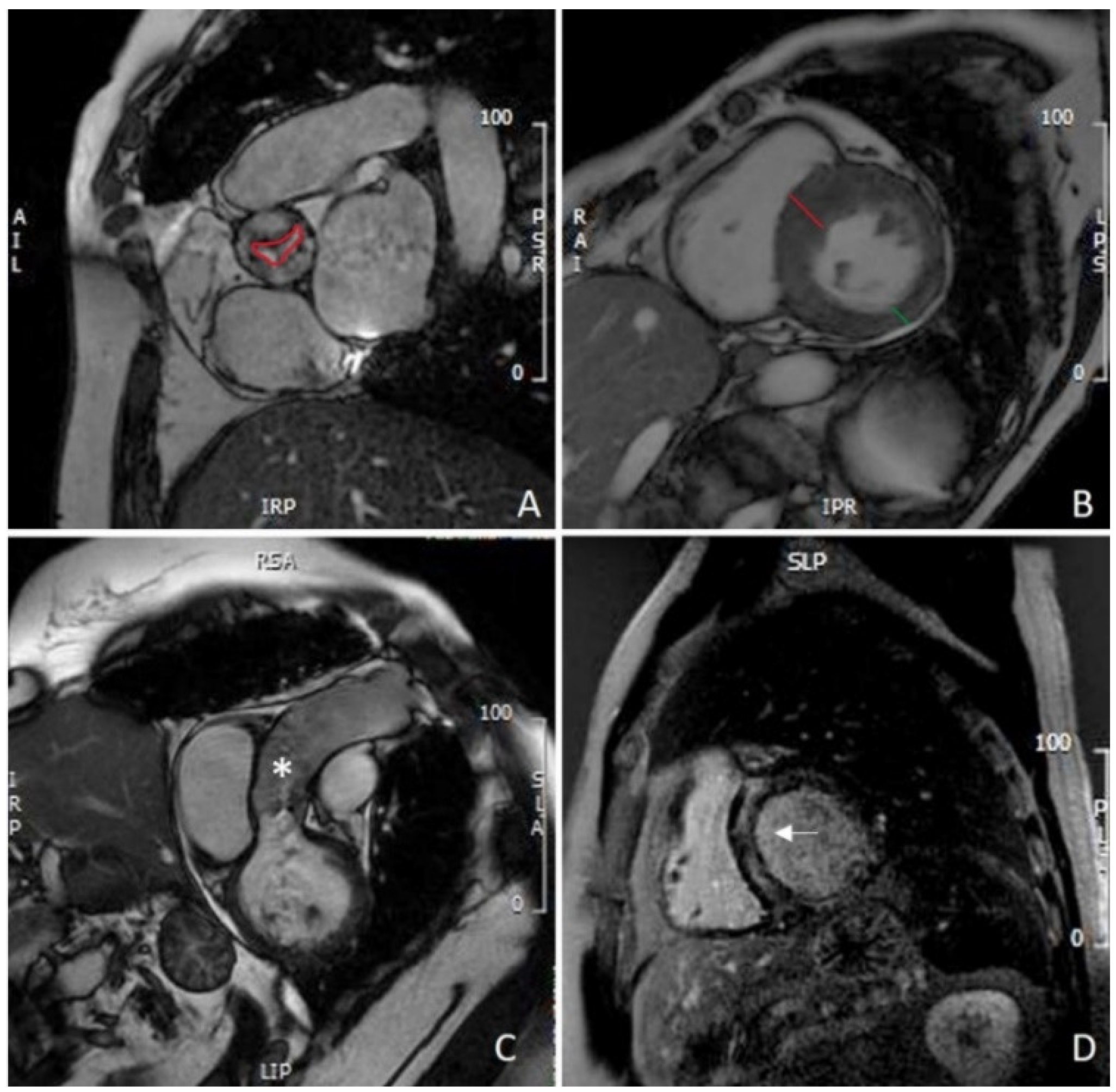 Fem subtraktion modtage JCDD | Free Full-Text | The Role of Cardiac Magnetic Resonance in Aortic  Stenosis and Regurgitation
