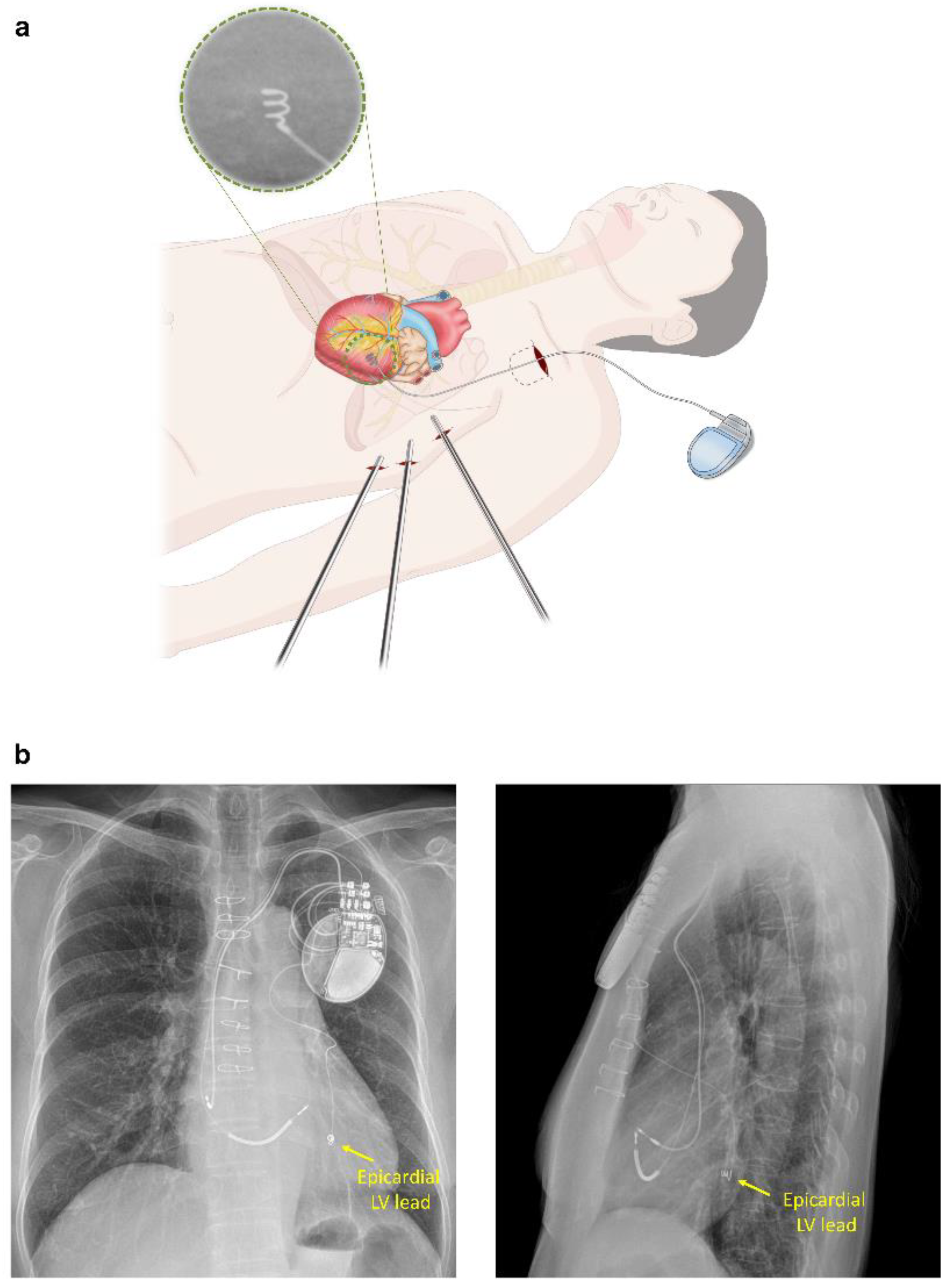 JCDD Free FullText Thoracoscopic Implantation of Epicardial Left
