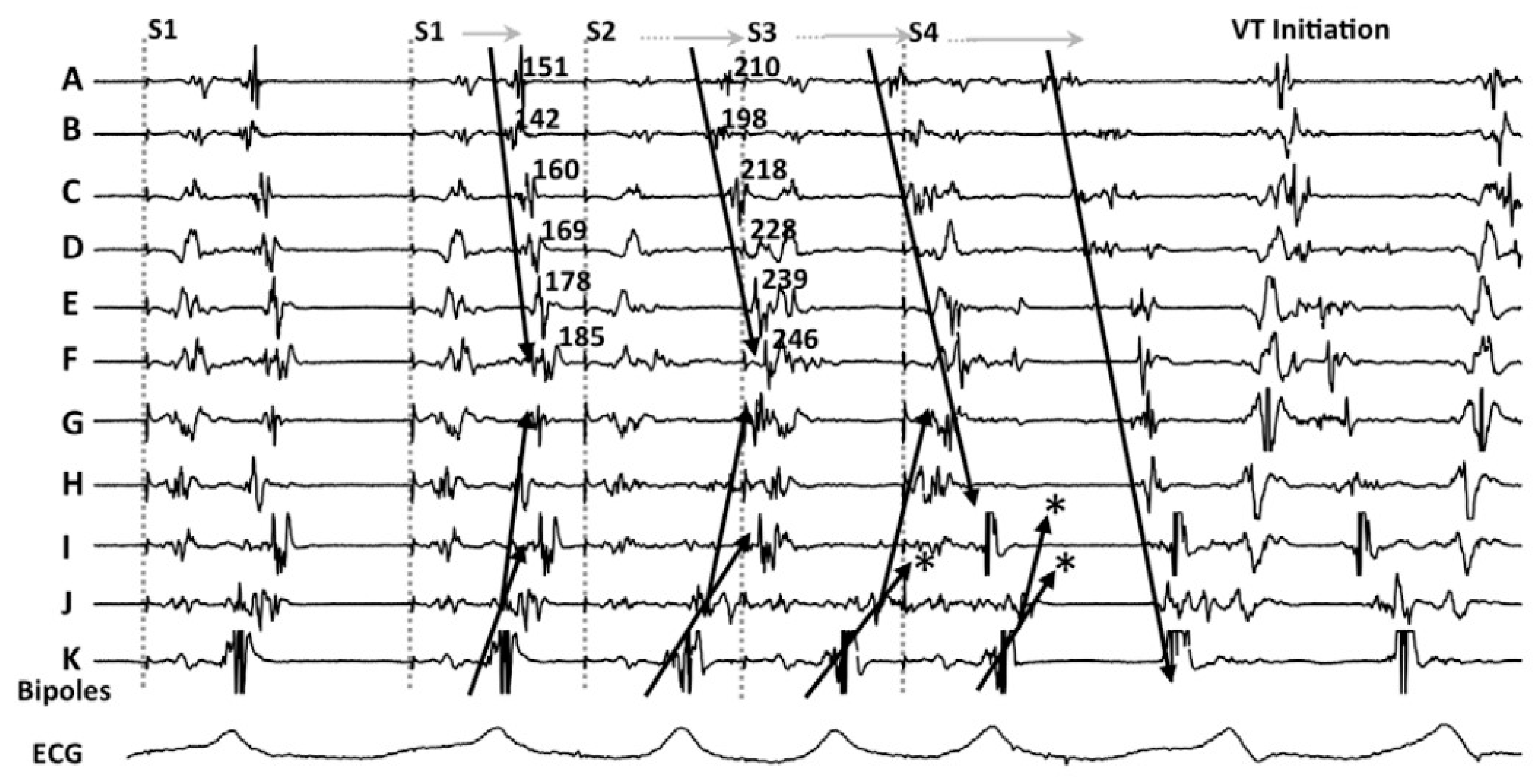 Impact of sex on clinical, procedural characteristics and outcomes of  catheter ablation for ventricular arrhythmias according to underlying heart  disease