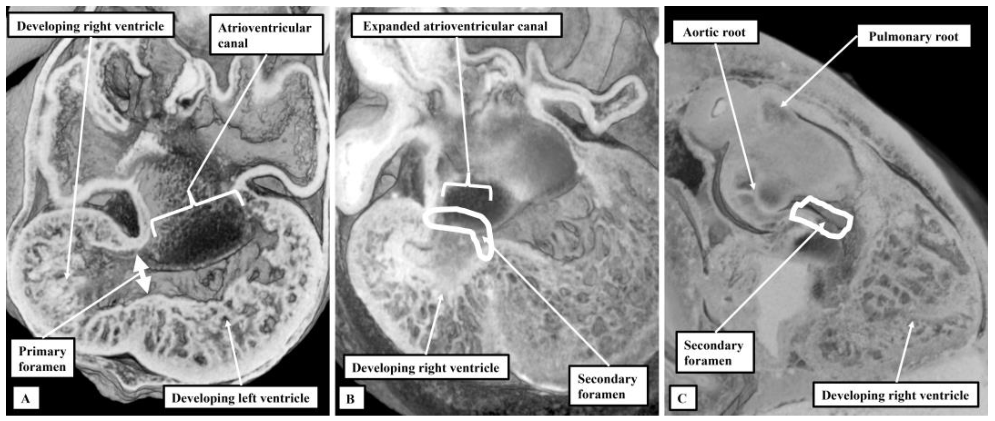 What Is the Hypoplastic Left Heart Syndrome?