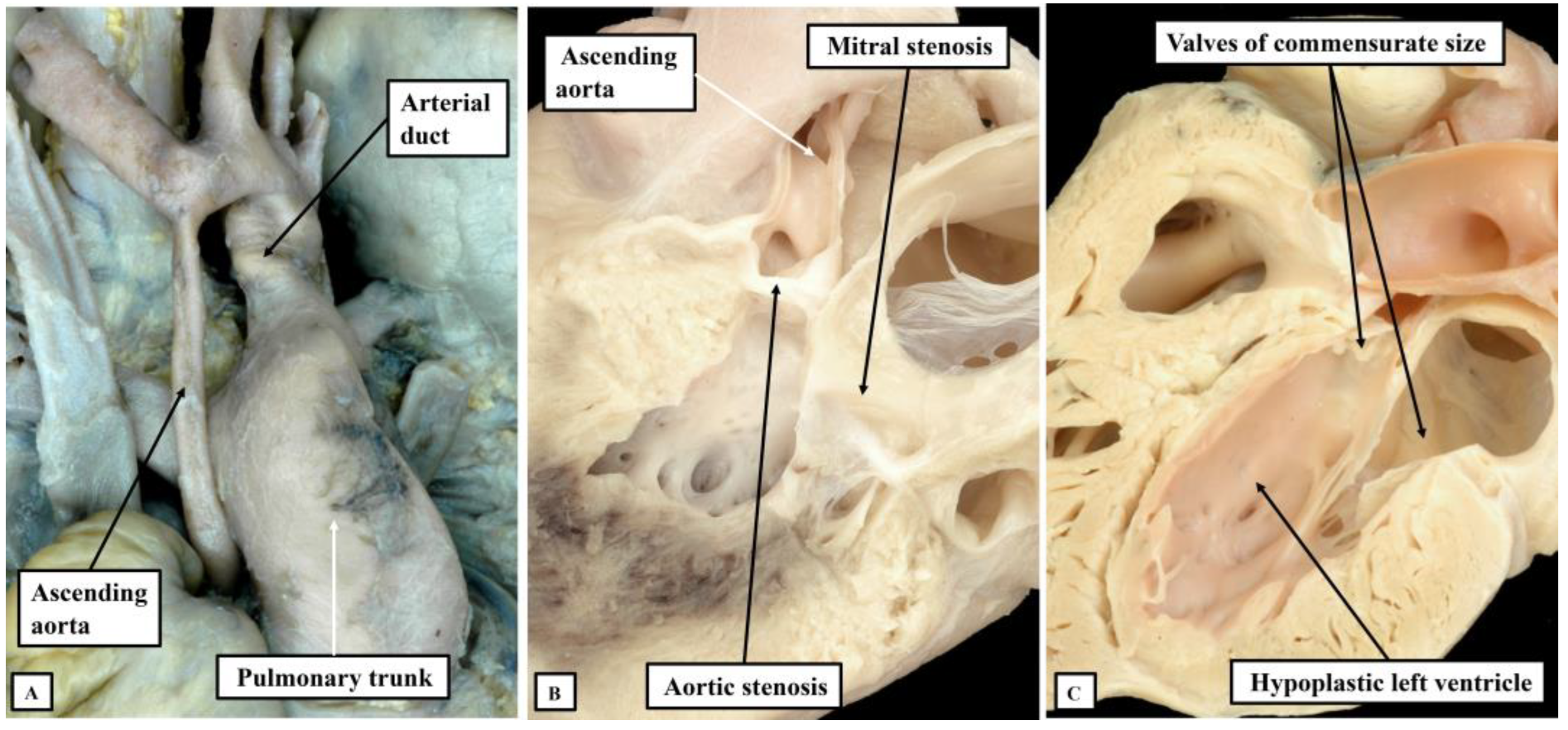 What Is the Hypoplastic Left Heart Syndrome?
