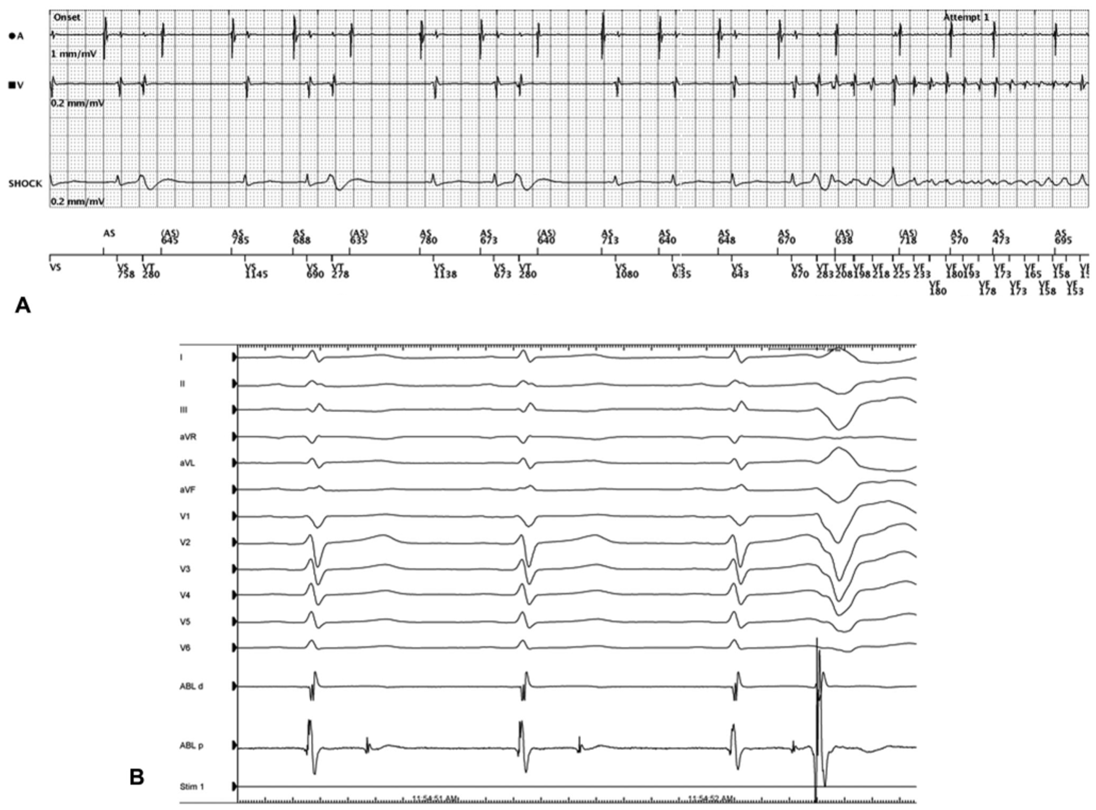 This Simple Test Could Detect Pvc Icd 10 Early - nynaqri