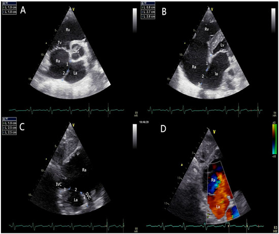 Complete Transthoracic Echocardiography for the Assessment and Guidance ...