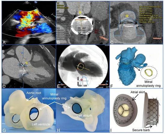 Dynamic Annular Geometry and Function in Patients with Mitral  Regurgitation: Insight From Three-Dimensional Annular Tracking | Thoracic  Key