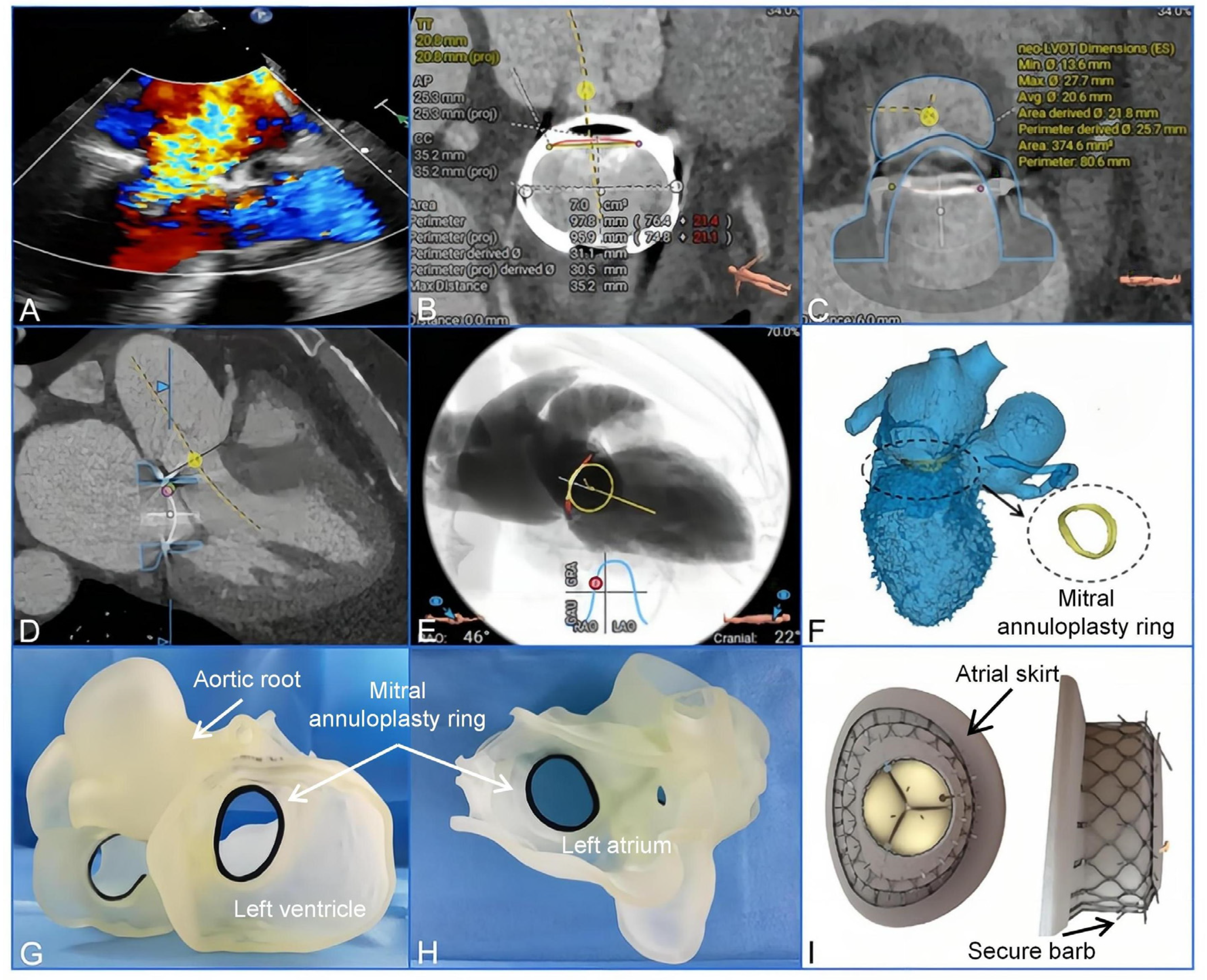 Mitral Valve