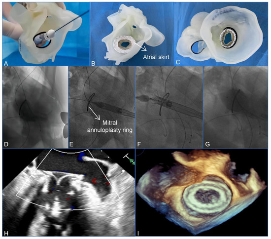 Mitral Valve Prolapse Repair | Baylor Medicine