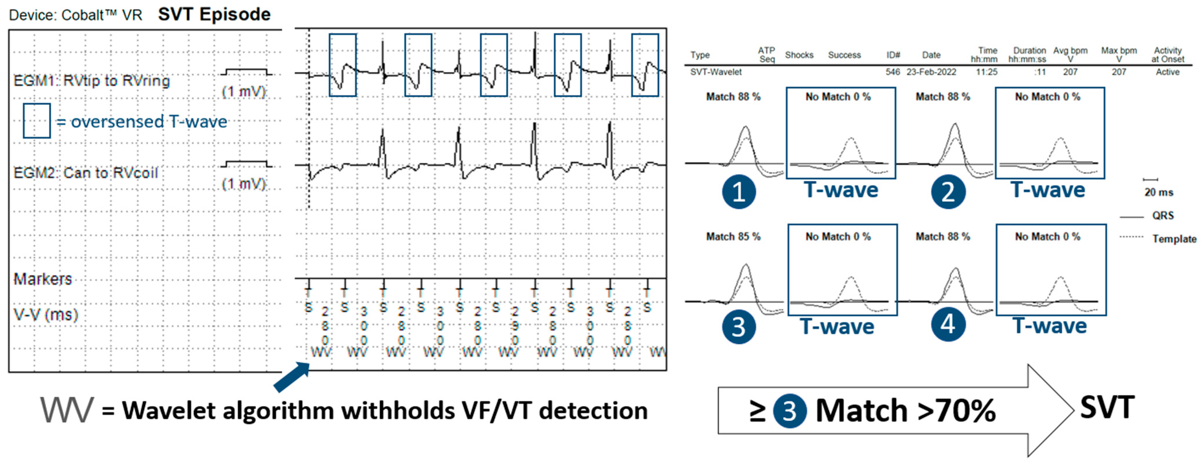This Simple Test Could Detect Pvc Icd 10 Early - 3t83gc6