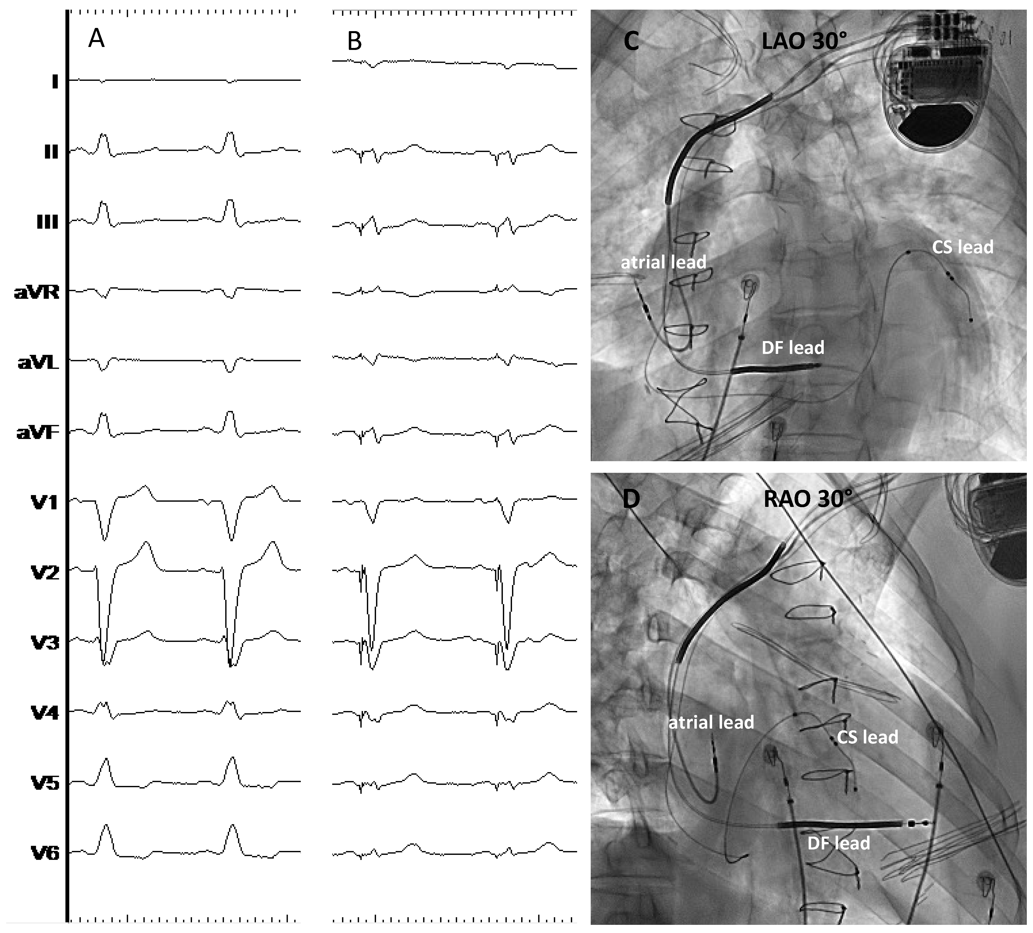 Nonspecific intraventricular conduction delay (defect) – ECG & ECHO